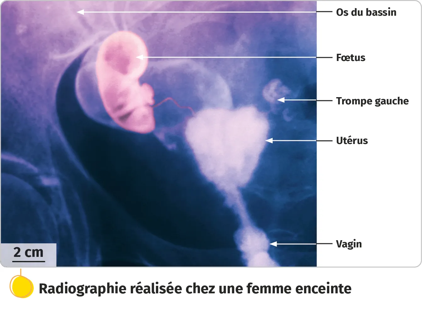 Radiographie réalisée chez une femme enceinte