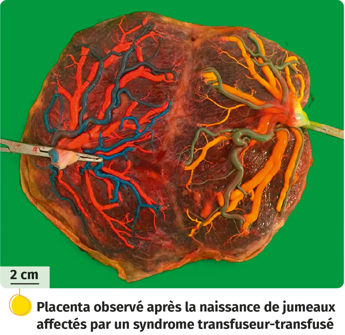 Placenta observé après la naissance de jumeaux affectés par un syndrome transfuseur-transfusé