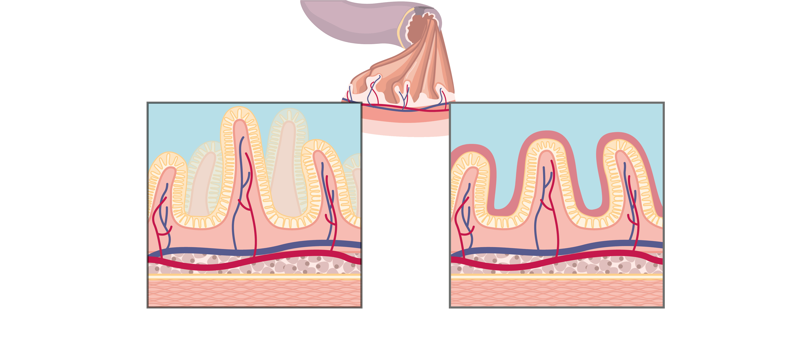 <stamp theme='svt-green1'>Doc. 1</stamp> Schéma comparatif des villosités (en coupe transversale) d’un intestin normal (à gauche) et d’un intestin d’une personne intolérante au gluten mais n’ayant pas encore modifié son alimentation (à droite).