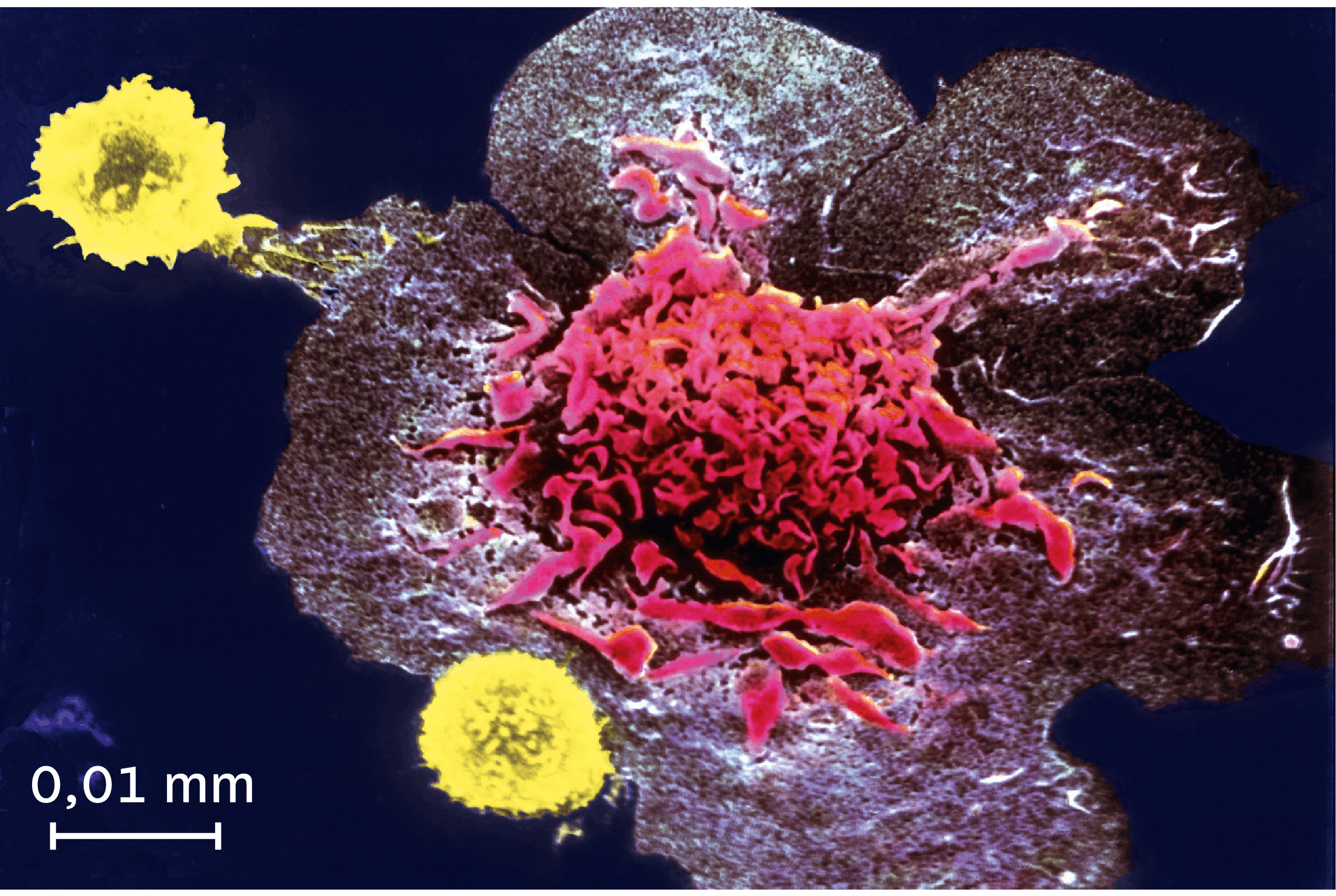<stamp theme='svt-green1'>Doc. 3</stamp> La destruction d’une cellule infectée par des lymphocytes T observée au microscope électronique à balayage (image colorisée).