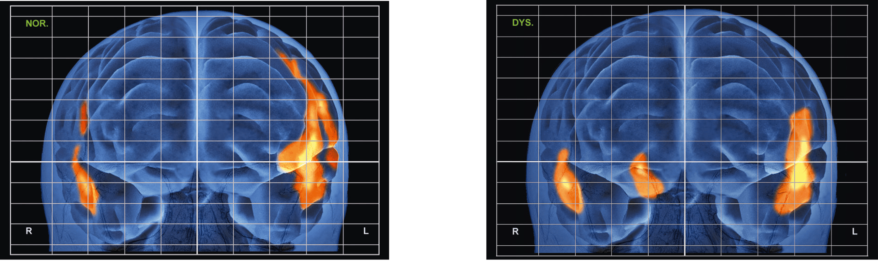 <stamp theme='svt-green1'>Doc. 4</stamp> Les activations cérébrales d’un patient témoin (gauche) ou dyslexique (droite) en train de lire. Il s’agit d’une reconstruction 3D du cerveau.