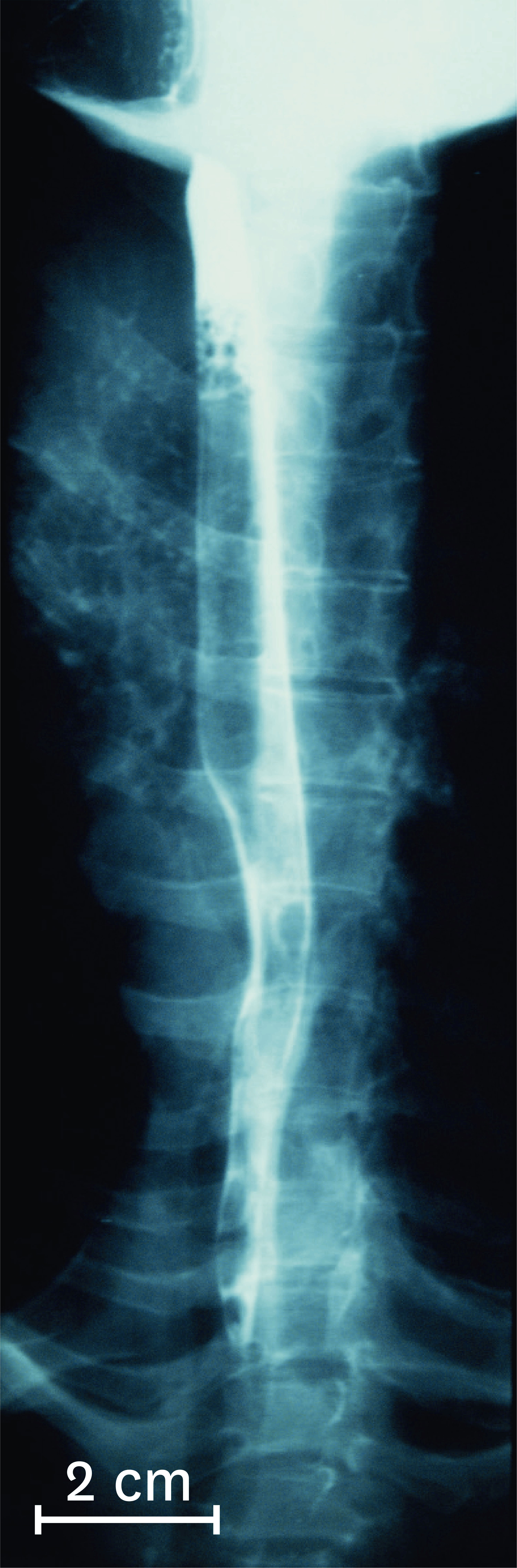 <stamp theme='svt-green1'>Doc. 3</stamp> Une radiographie de l’oesophage chez un être humain, quelques secondes après ingestion du produit visible aux rayons X.