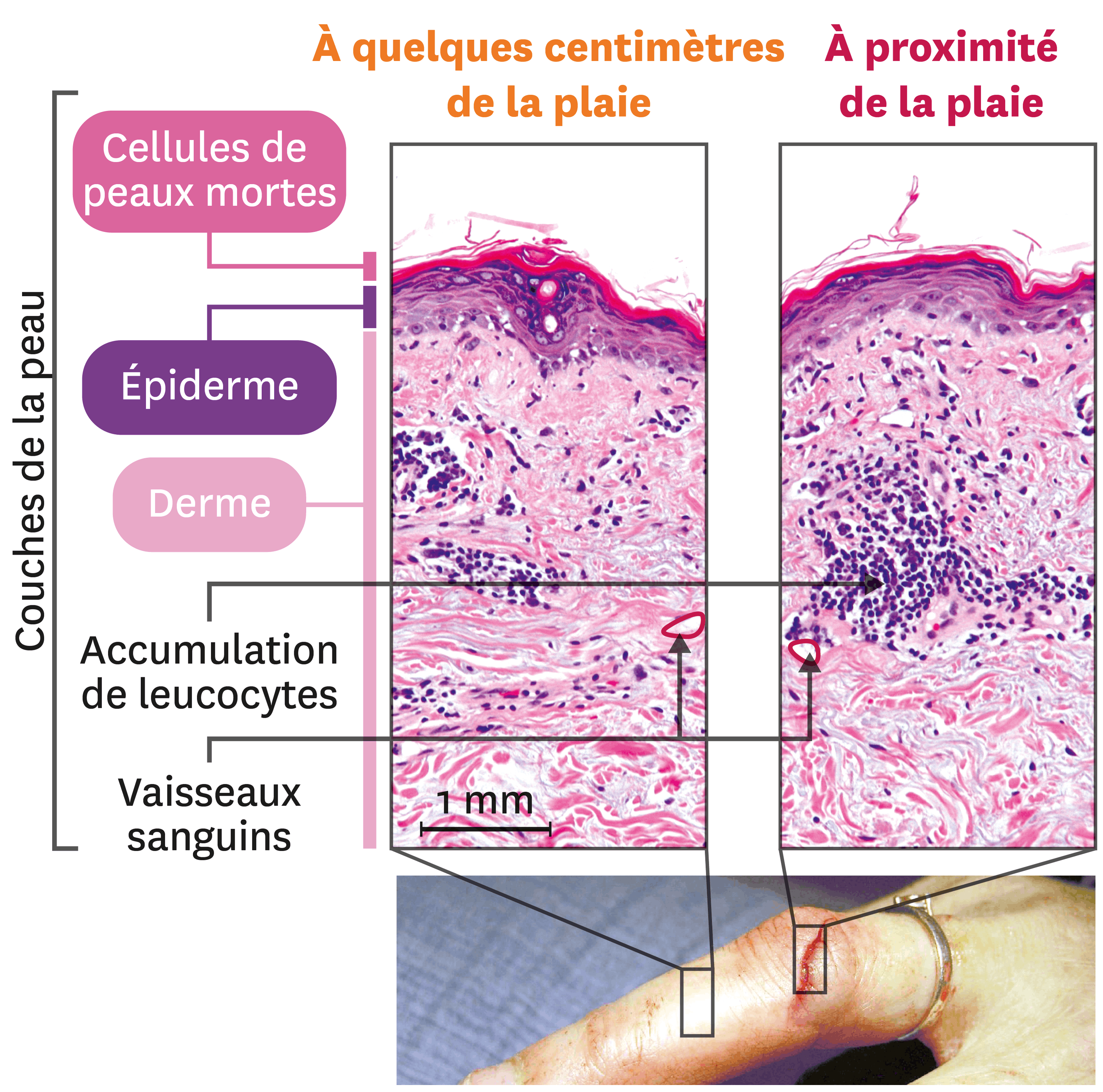 Distribution De La Mort Dans La Peau Comment se déclenche une réponse immunitaire ? | Lelivrescolaire.fr