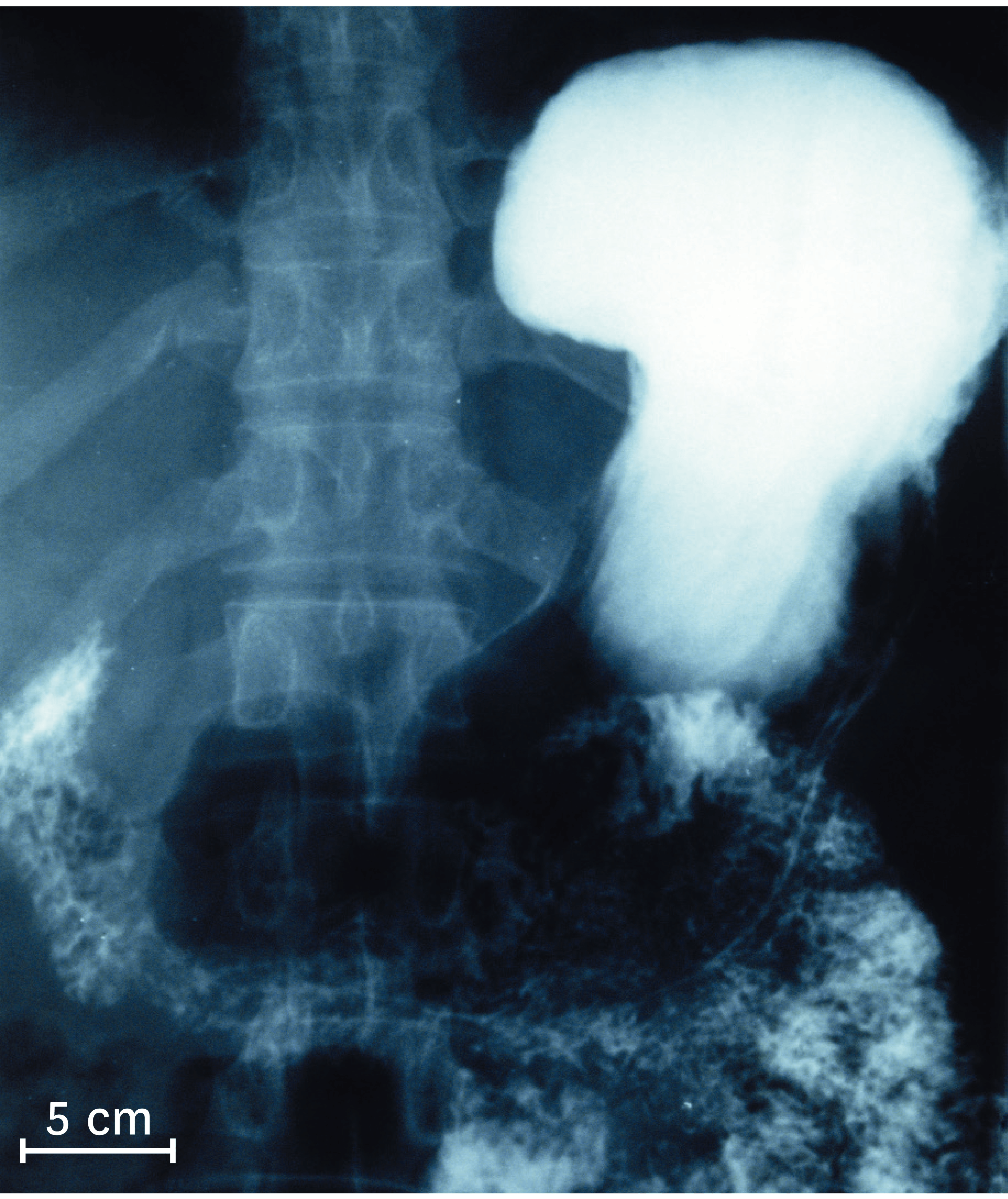 <stamp theme='svt-green1'>Doc. 4</stamp> Une radiographie de l’estomac chez un être humain 2 à 6 heures après ingestion du produit.