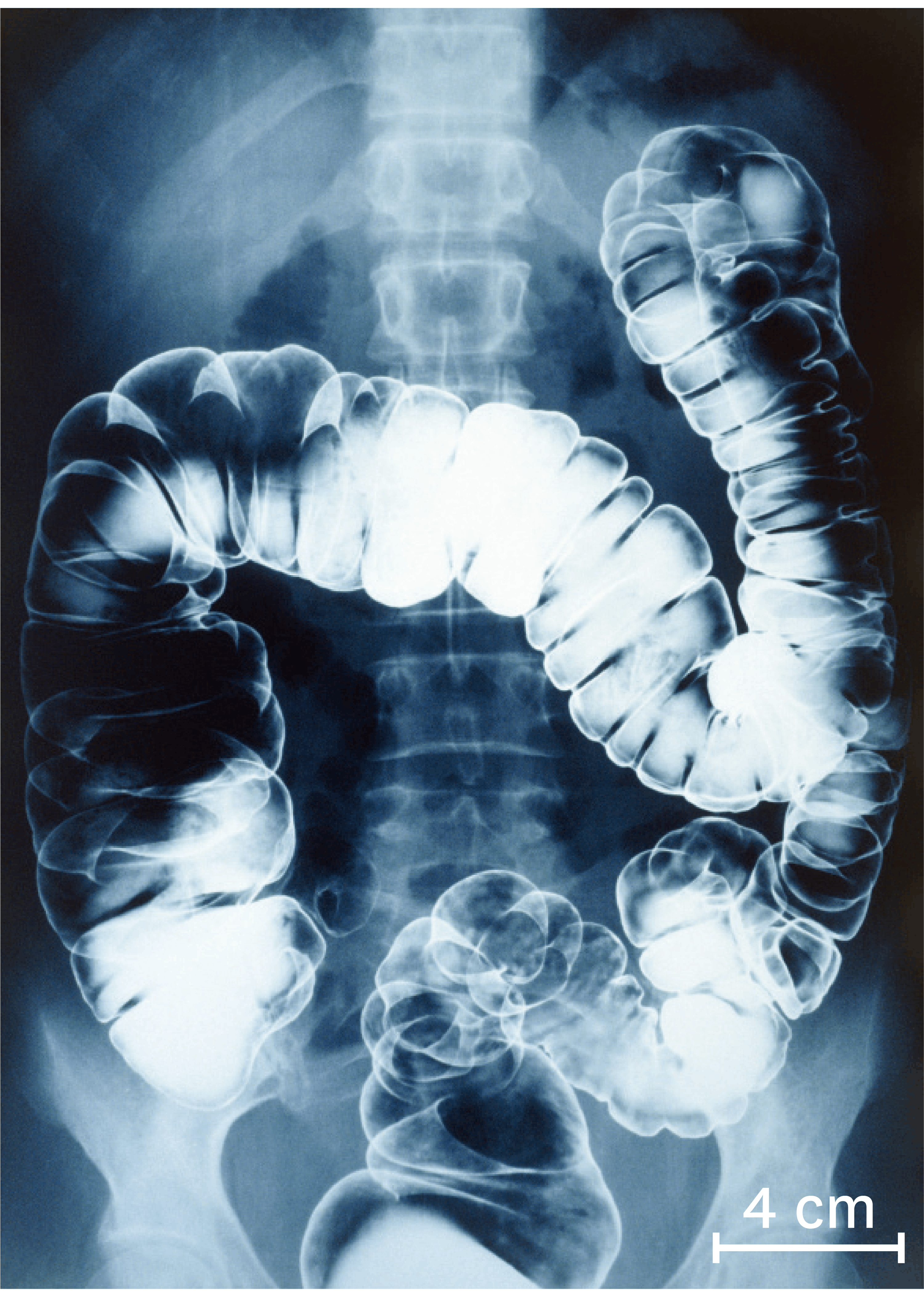 <stamp theme='svt-green1'>Doc. 6</stamp> Une radiographie du gros intestin chez un être humain 10 à 15 heures après ingestion du produit.
