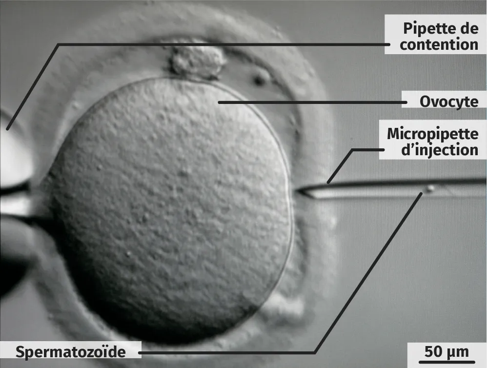 Le principe de l'ICSI (injection intracytoplasmique de spermatozoïde).