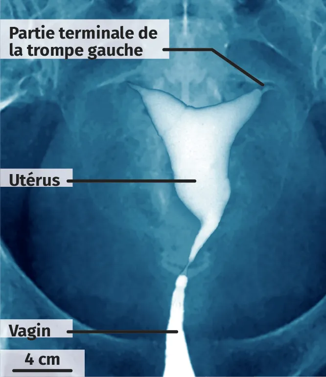 Hystérosalpingographie de l'utérus de Mme B.