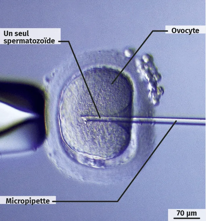 L'injection intracytoplasmique de spermatozoïde (ICSI) a été proposée au couple X qui n'arrive pas à avoir d'enfant.