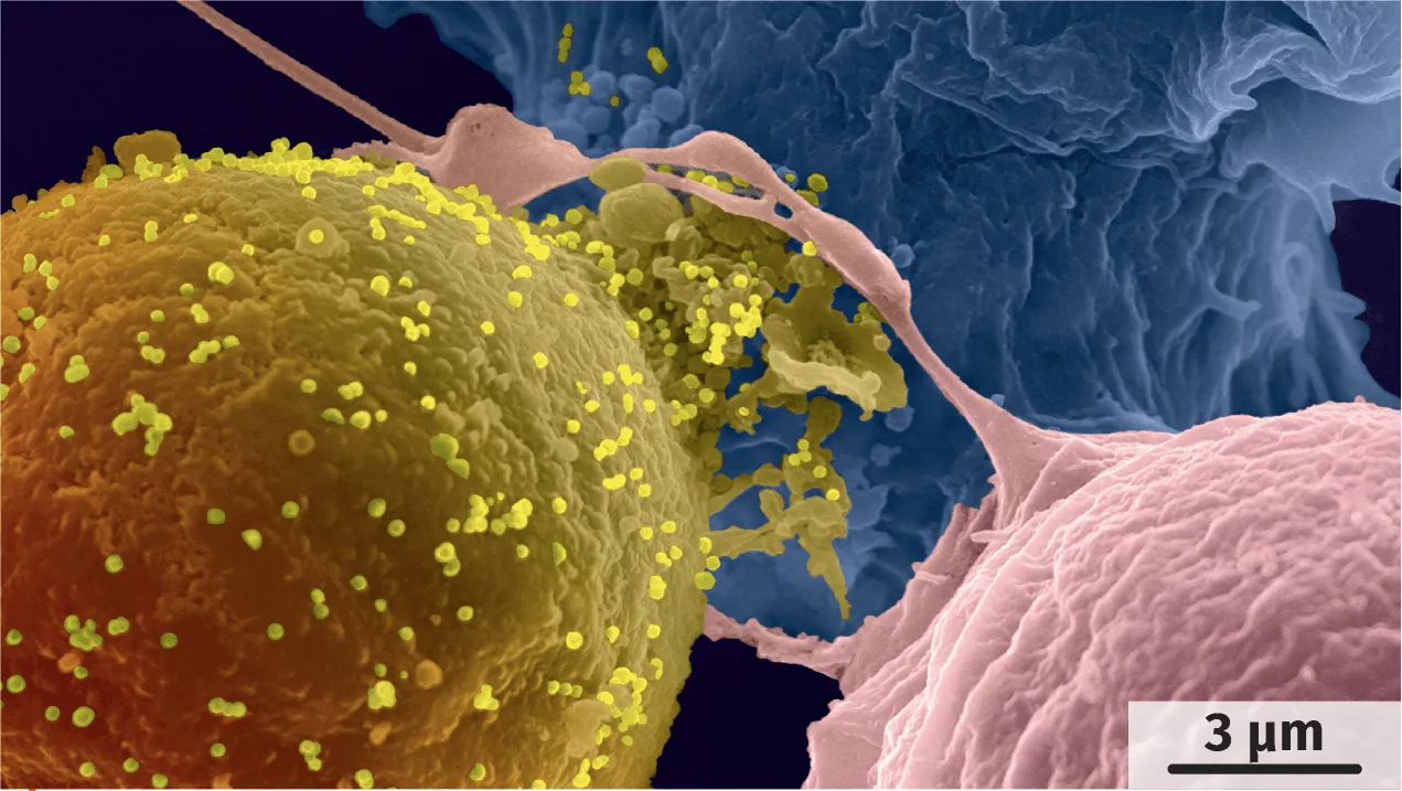 Infection d'une cellule par le VIH (MEB, image colorisée).