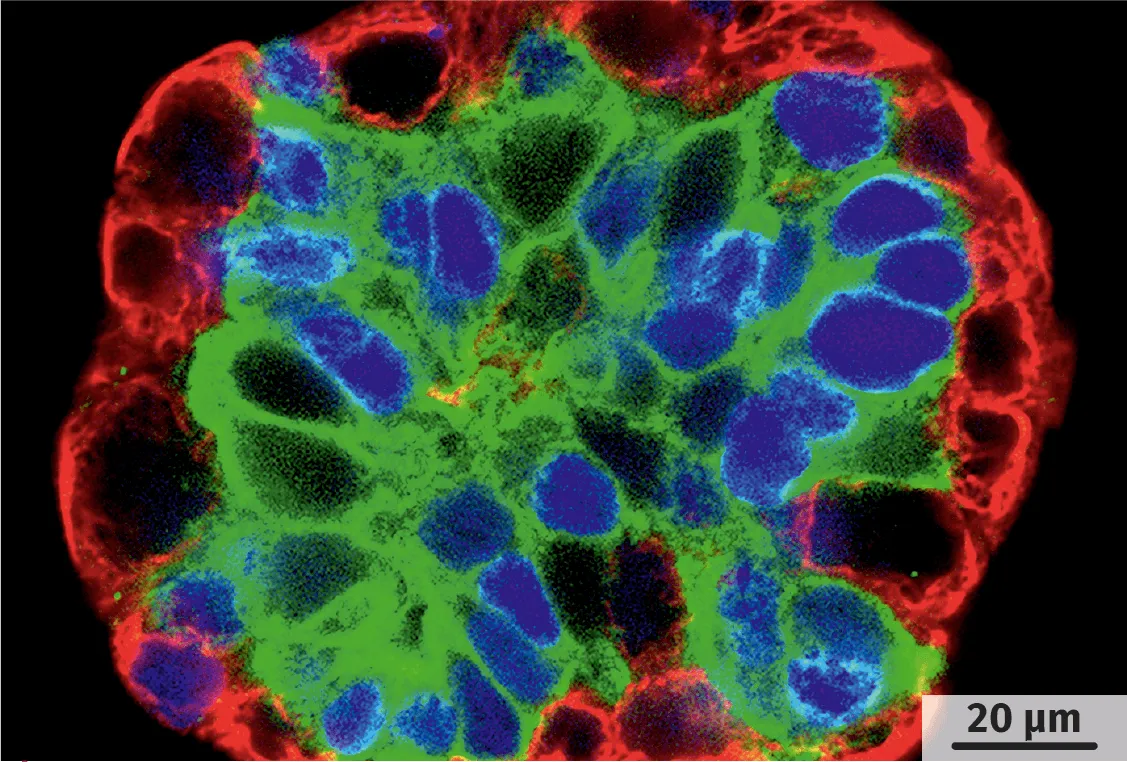 Cellules cancéreuses (microscopie à fluorescence).