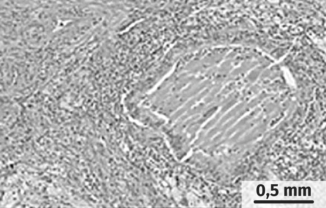 Bronches d'un individu atteint de mucoviscidose et d'un individu sain observées au microscope optique