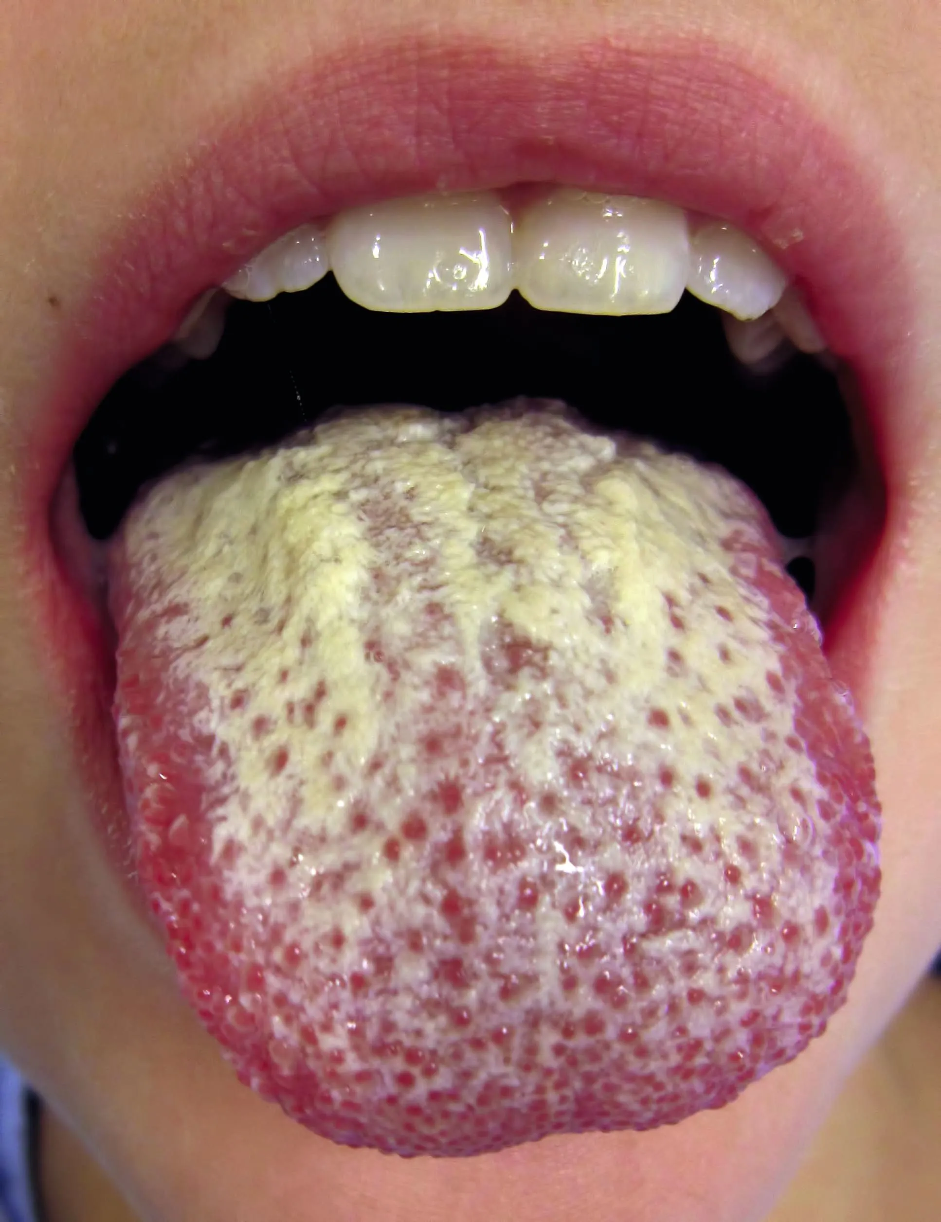  Taches blanches sur la langue en cas de candidose buccale