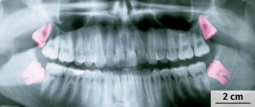 Radiographie des dents chez l'être humain adulte, vue de face