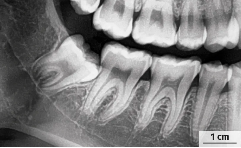 Radiographie d'un patient avant l'extraction de la molaire M3