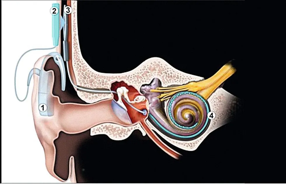 Schéma d'un implant cochléaire