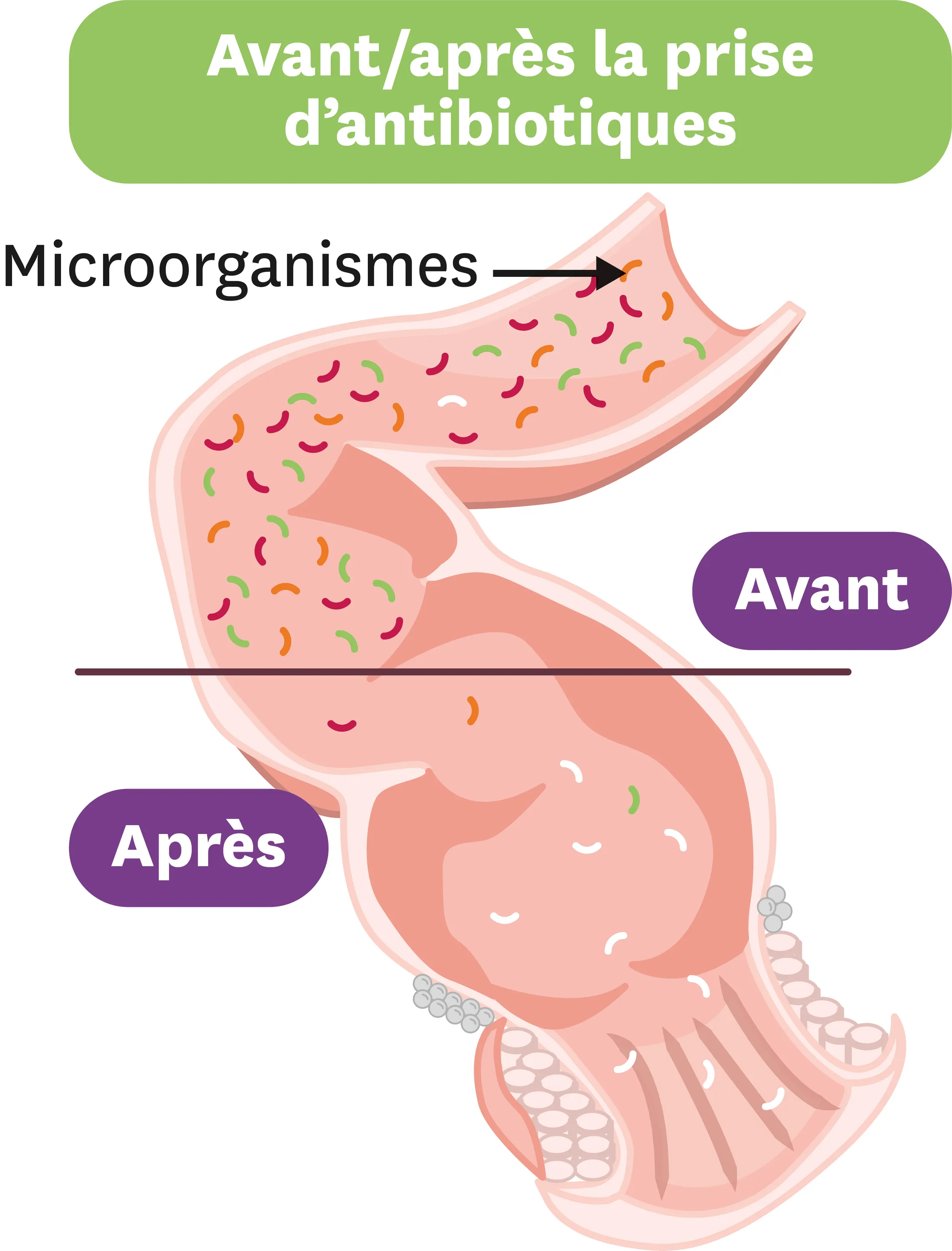 L'effet des antiobiotiques sur le microbiote intestinal.