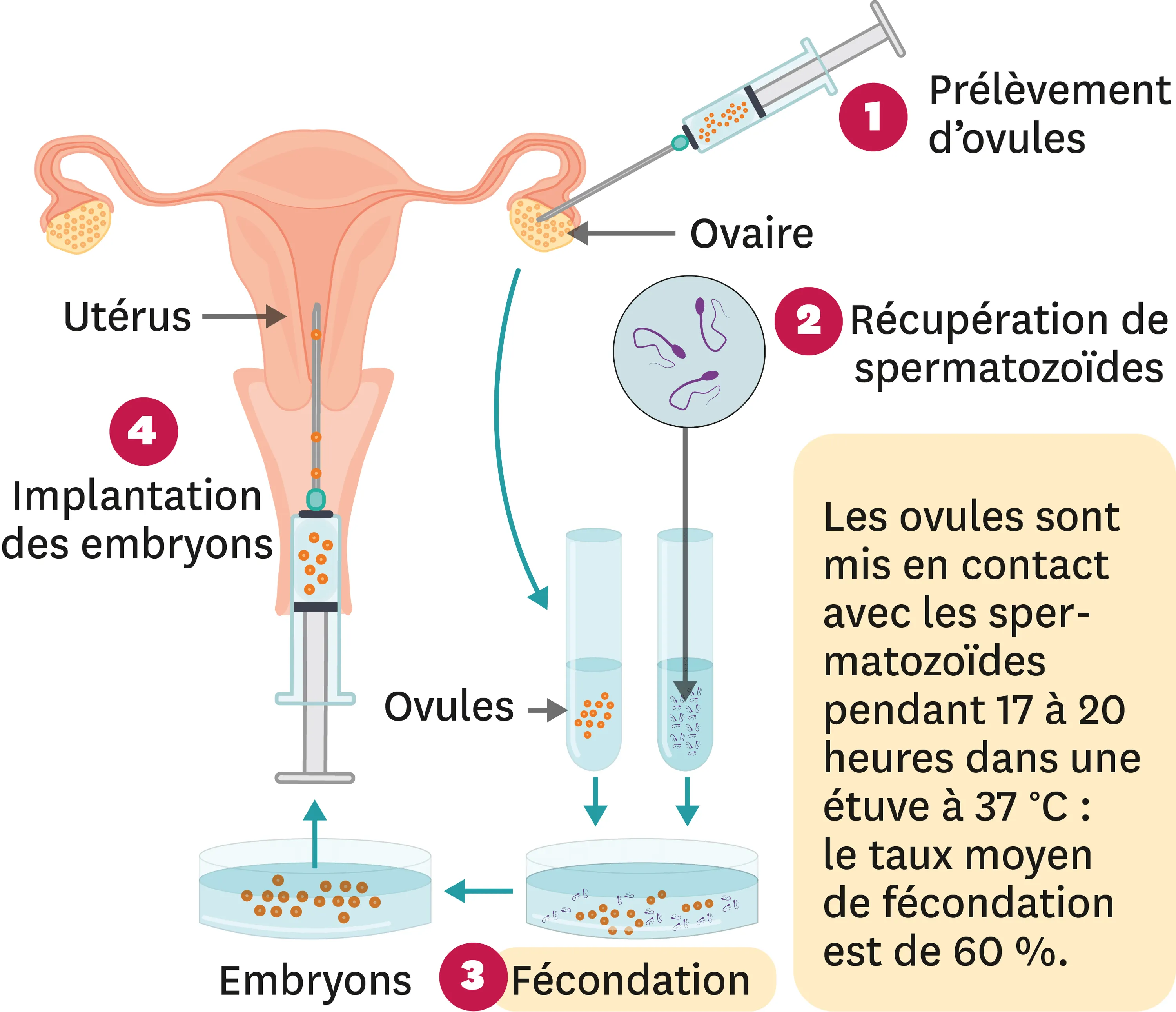 Le principe de la FIVETE (Fécondation In Vitro Et Transfert d'Embryon).