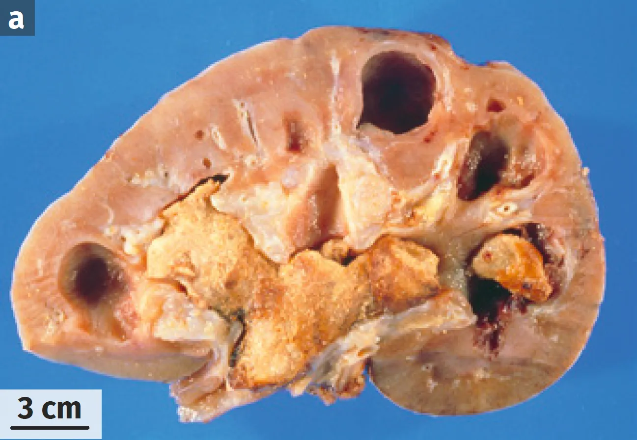 Coupe longitudinale d'un rein montrant l'obstruction des voies urinaires par des calculs rénaux.