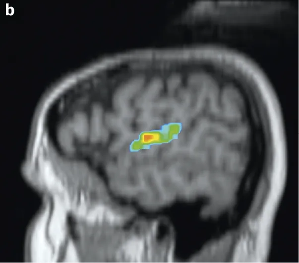 IRMf montrant les zones du cerveau activées chez un individu écoutant de la musique. Images issues du logiciel ÉduAnat2. Coupe sagittale.