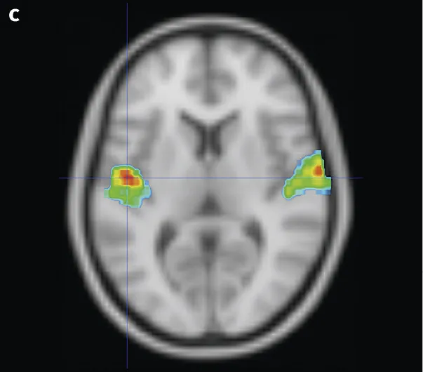 IRMf montrant les zones du cerveau activées chez un individu écoutant de la musique. Images issues du logiciel ÉduAnat2. Coupe transversale.