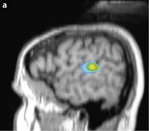 IRMf montrant les zones du cerveau activées chez un individu entendant deux syllabes énoncées. Coupe sagittale.