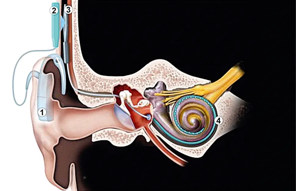 Schéma d'un implant cochléaire