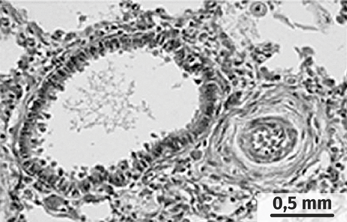 Bronches d’un individu atteint de mucoviscidose et d’un individu sain observées au microscope optique